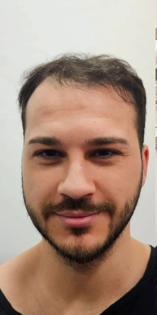 Prima del trapianto