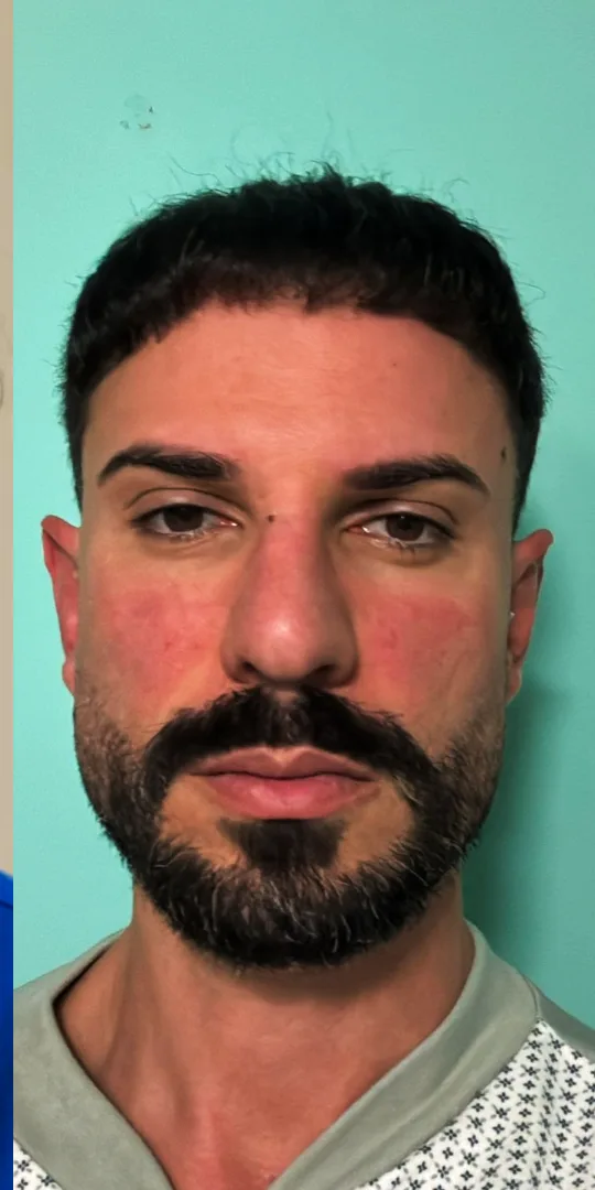 Dopo il trapianto