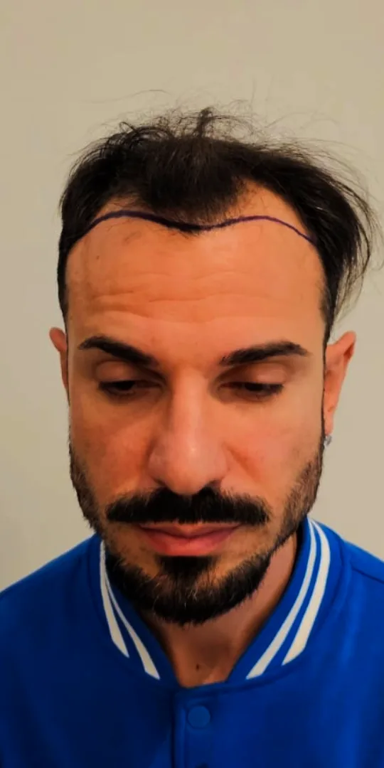 Prima del trapianto